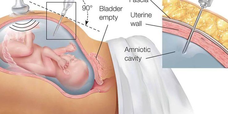 amniyosentez