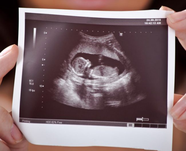 down-sendromu-taramalari-ailelere-bilgi