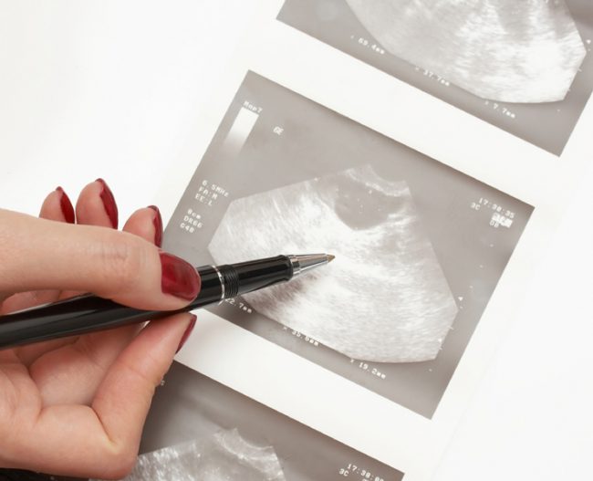 embriyo-redüksiyonu